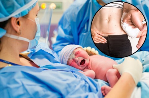 normal and c section delivery
